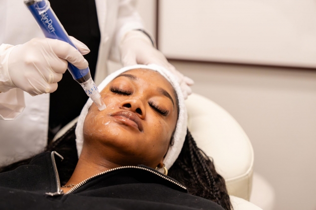 Does Microneedling Fade Skin Discoloration?